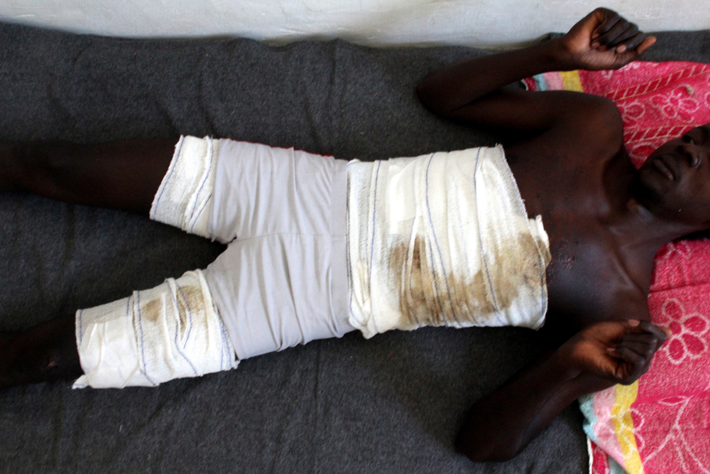 Un sopravvissuto di un naufragio all'interno di un centro di detenzione libico. Ha ustioni estese su tutto il corpo, causate dal carburante / MSF