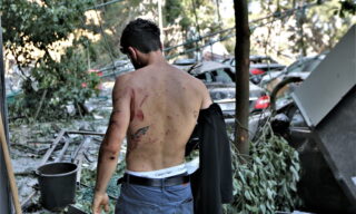 Aftermath of massive blast in Beirut epa08585521 A Lebanese person shows injuries on the back after the massive explosion in Beirut, Lebanon, 05 August 2020. According to Beirut's Governor Marwan Abboud, at least 100 people were killed and more than 4,000 were injured after an explosion, caused by over 2,500 tons of ammonium nitrate stored in a warehouse, devastated the port area on 04 August. EPA/NABIL MOUNZER
